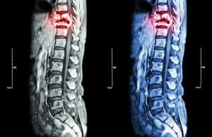 Spinal Cord Injury and Secondary Health Complications