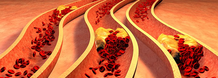 Memphis IVC Filter Recovery Blood Clot Filter Lawyer