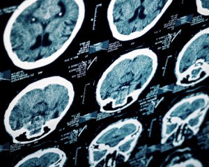 Jury Awards $44 Million for Brain Injury Medical Malpractice Verdict