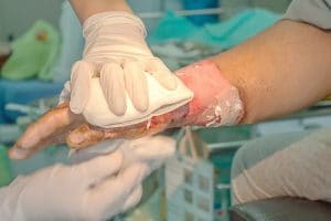 What You Need to Know about Recovering from Burn Injuries